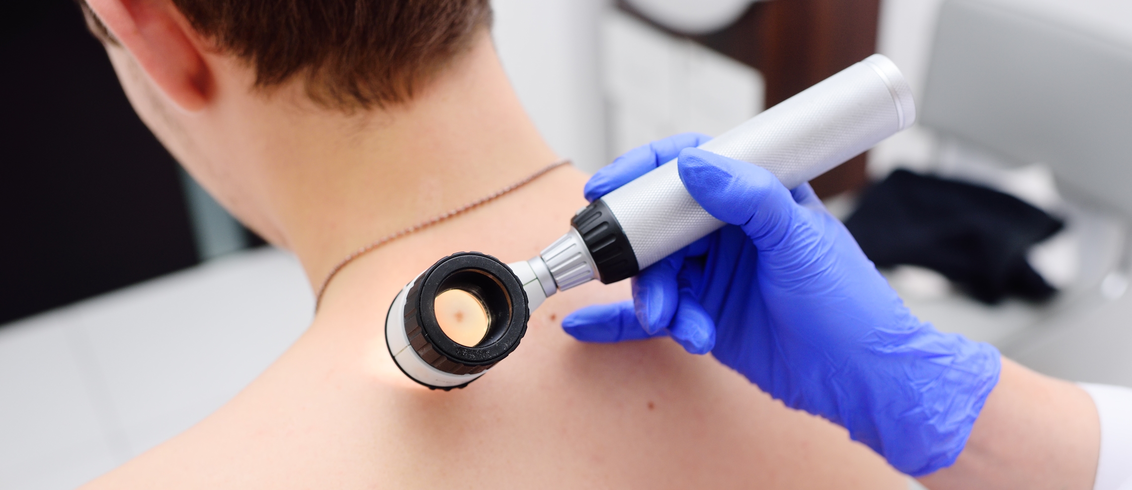 Melanoma-screening-shutterstock_1017095722_reduced